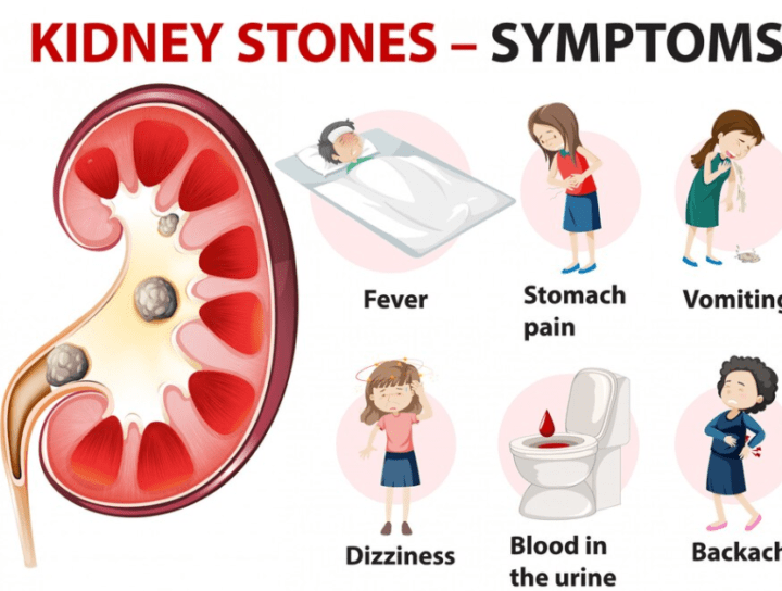 Symptoms of Kidney Stones
