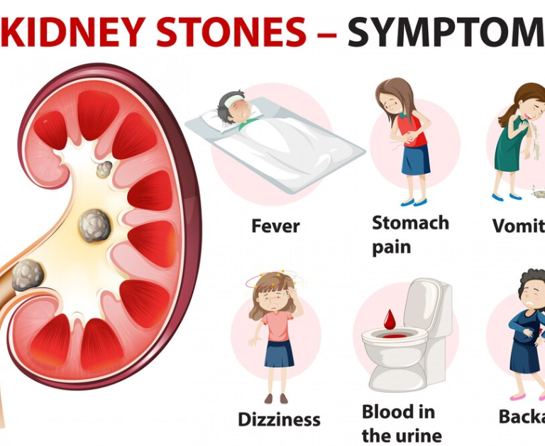 Symptoms of Kidney Stones