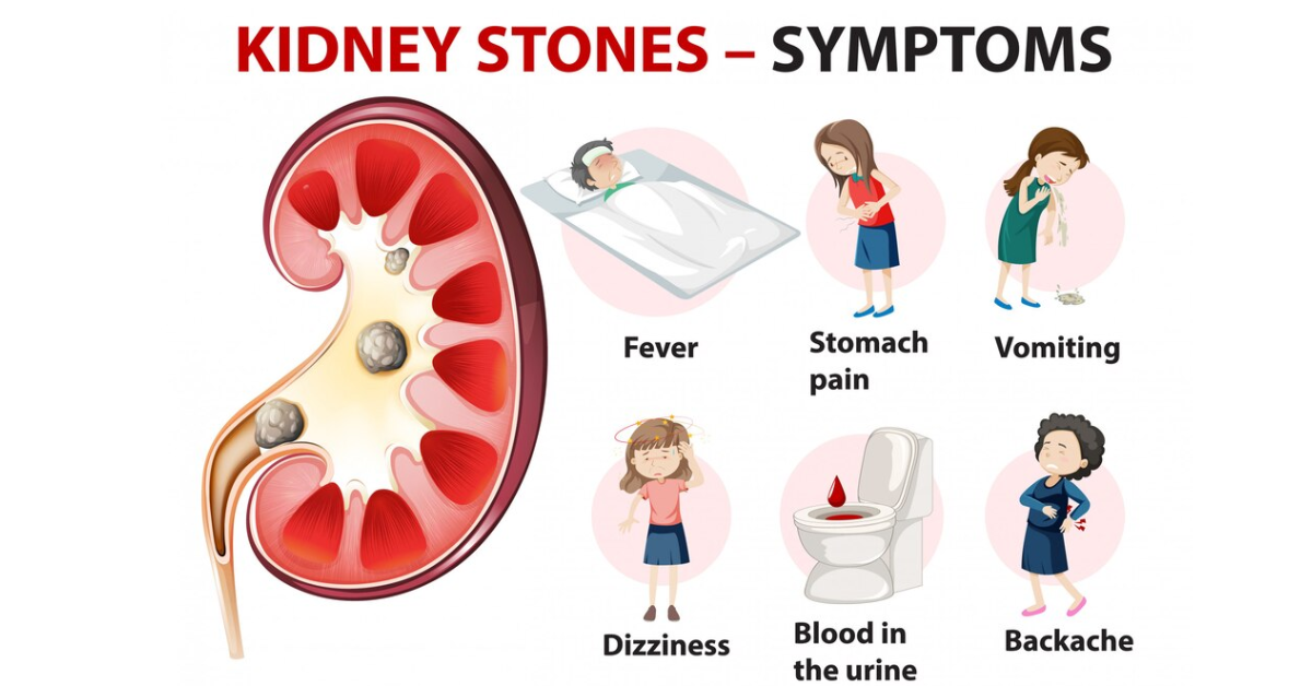 Symptoms of Kidney Stones